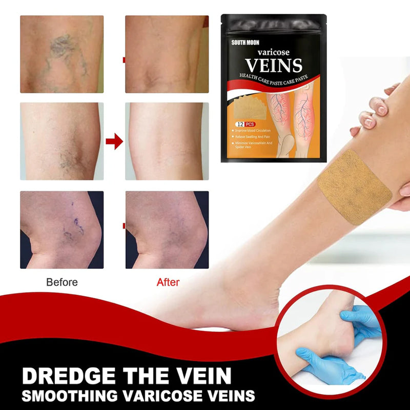 Parches para tratamiento de varices