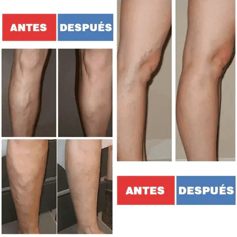 Parches para tratamiento de varices