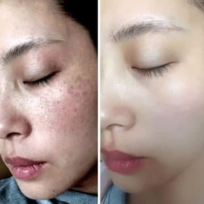 Gel Acne - Rey del tratamiento del melasma y las pecas